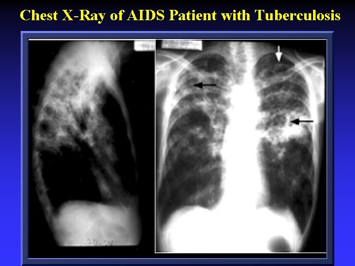 Chest X-Ray of AIDS Patient with Tuberculosis 