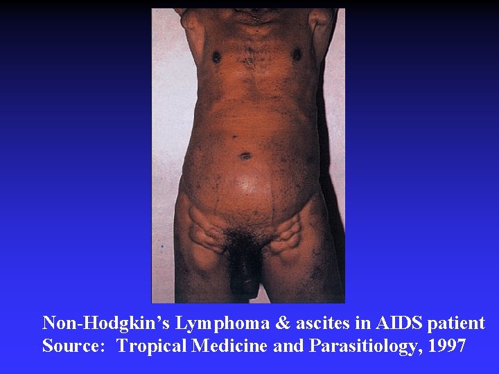 Non-Hodgkin’s Lymphoma & ascites in AIDS patient Source: Tropical Medicine and Parasitiology, 1997 