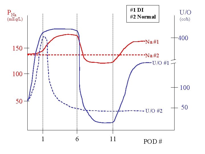 #1 DI #2 Normal PNa (m. Eq/L) Na #1 150 U/O (cc/h) 400 Na #1 DI #2 Normal PNa (m. Eq/L) Na #1 150 U/O (cc/h) 400 Na