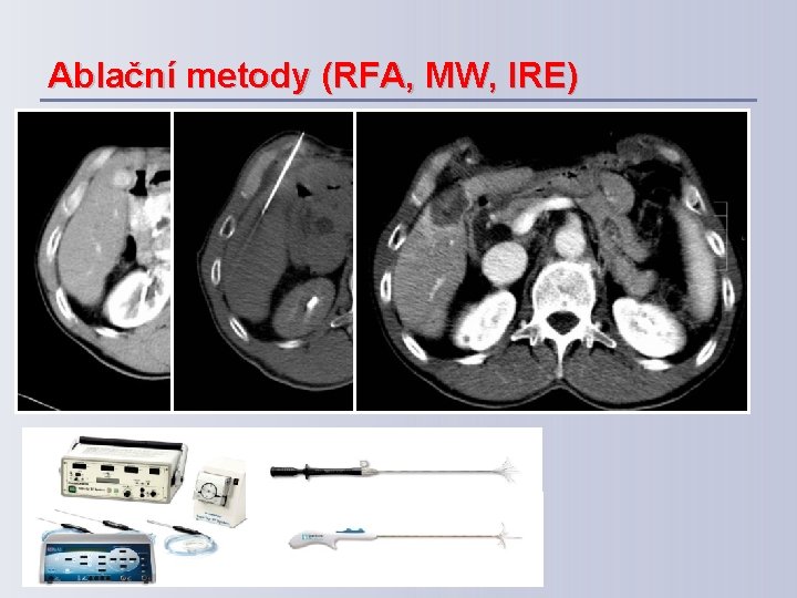 Ablační metody (RFA, MW, IRE) 