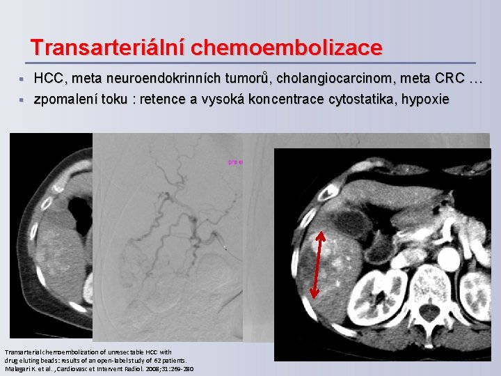 Transarteriální chemoembolizace § § HCC, meta neuroendokrinních tumorů, cholangiocarcinom, meta CRC … zpomalení toku