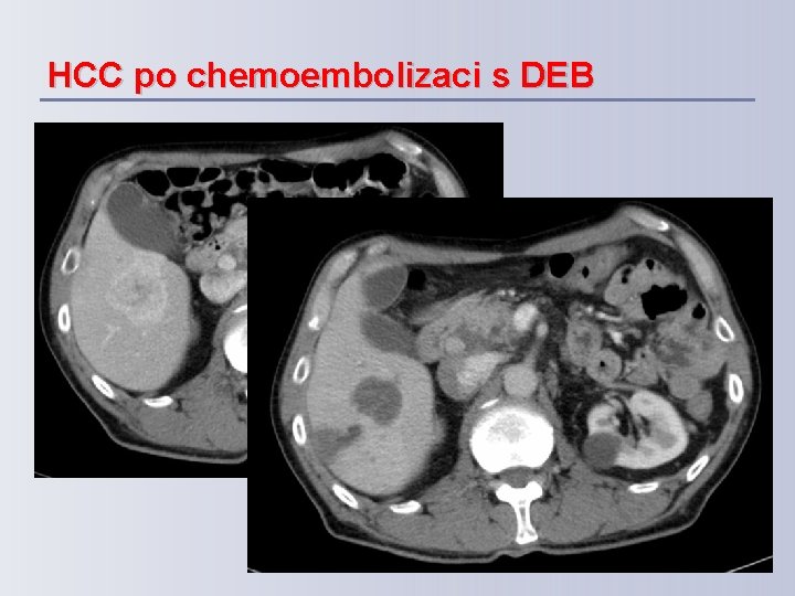 HCC po chemoembolizaci s DEB 