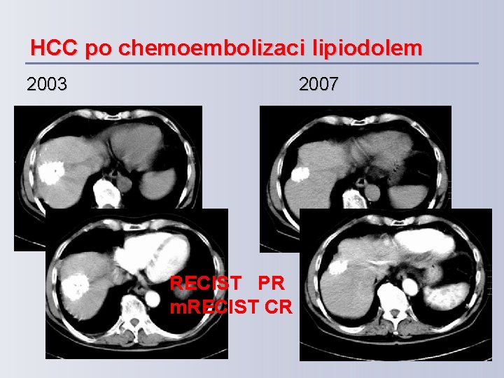 HCC po chemoembolizaci lipiodolem 2003 2007 RECIST PR m. RECIST CR 