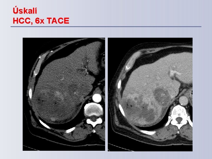 Úskalí HCC, 6 x TACE 