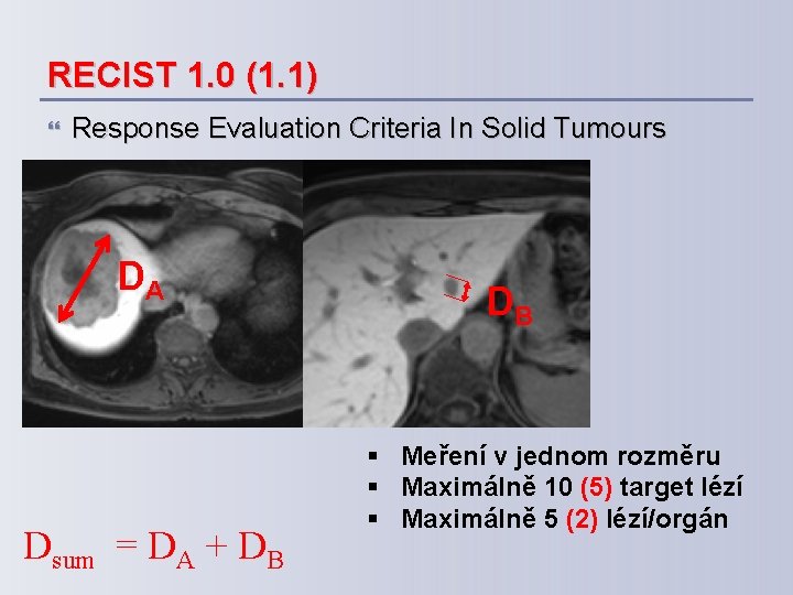 RECIST 1. 0 (1. 1) Response Evaluation Criteria In Solid Tumours DA Dsum =