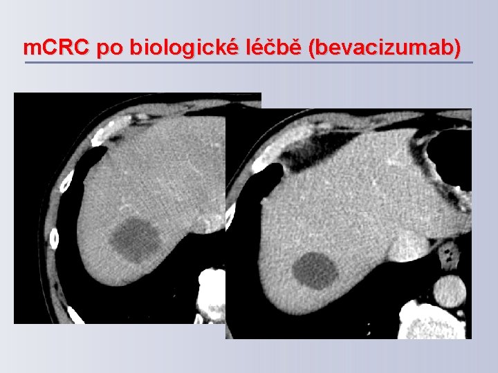 m. CRC po biologické léčbě (bevacizumab) 
