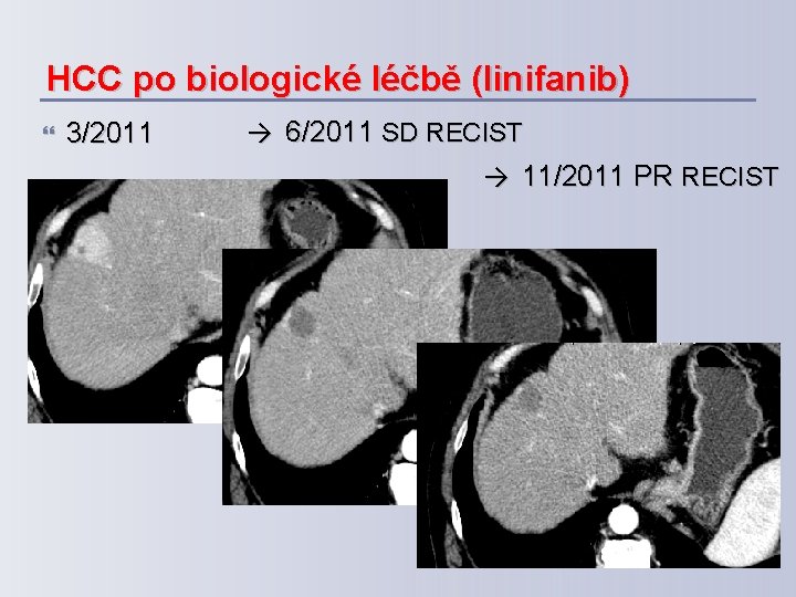 HCC po biologické léčbě (linifanib) 3/2011 → 6/2011 SD RECIST → 11/2011 PR RECIST