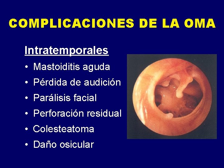 COMPLICACIONES DE LA OMA Intratemporales • Mastoiditis aguda • Pérdida de audición • Parálisis