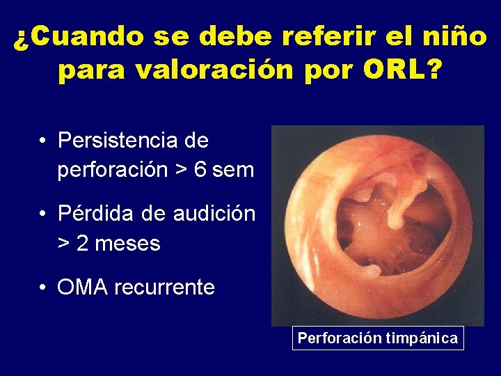 ¿Cuando se debe referir el niño para valoración por ORL? • Persistencia de perforación