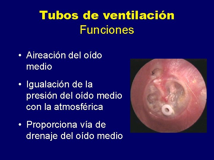 Tubos de ventilación Funciones • Aireación del oído medio • Igualación de la presión