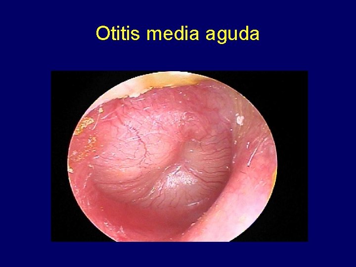 Otitis media aguda 