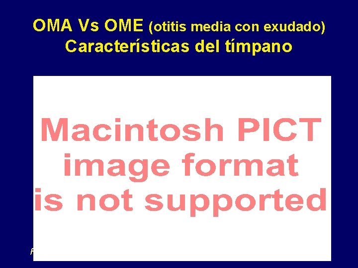 OMA Vs OME (otitis media con exudado) Características del tímpano Faden et al. Pediatr