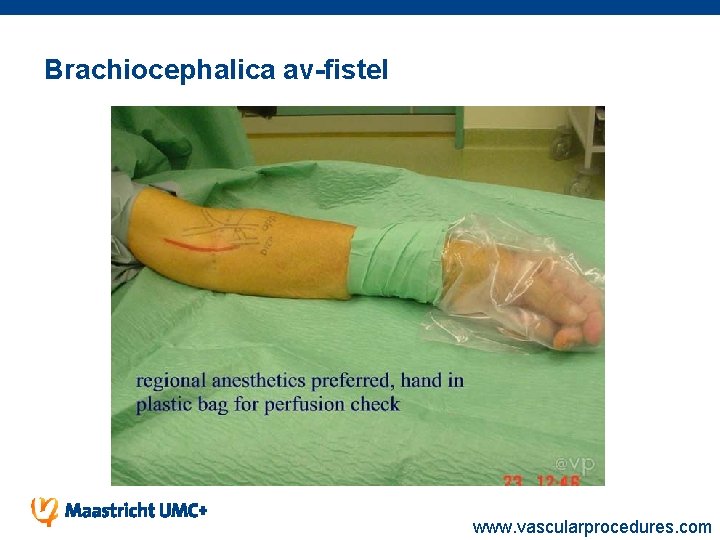 Brachiocephalica av-fistel www. vascularprocedures. com 