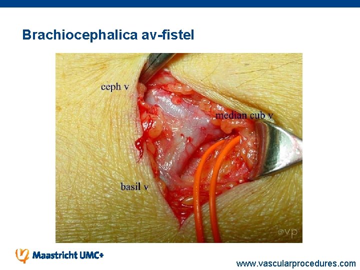 Brachiocephalica av-fistel www. vascularprocedures. com 