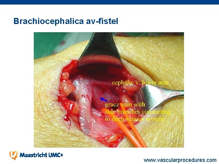 Brachiocephalica av-fistel www. vascularprocedures. com 