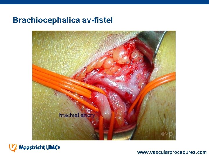 Brachiocephalica av-fistel www. vascularprocedures. com 