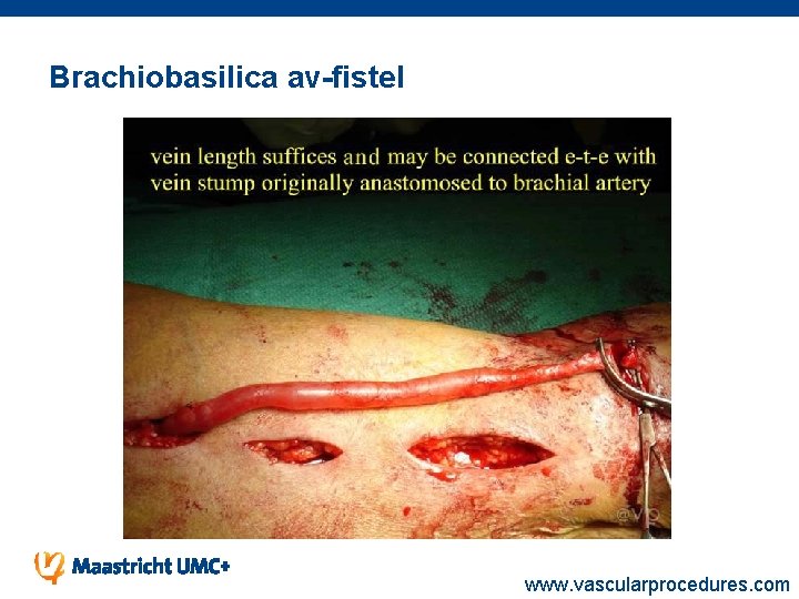 Brachiobasilica av-fistel www. vascularprocedures. com 