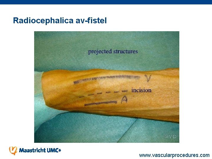 Radiocephalica av-fistel www. vascularprocedures. com 