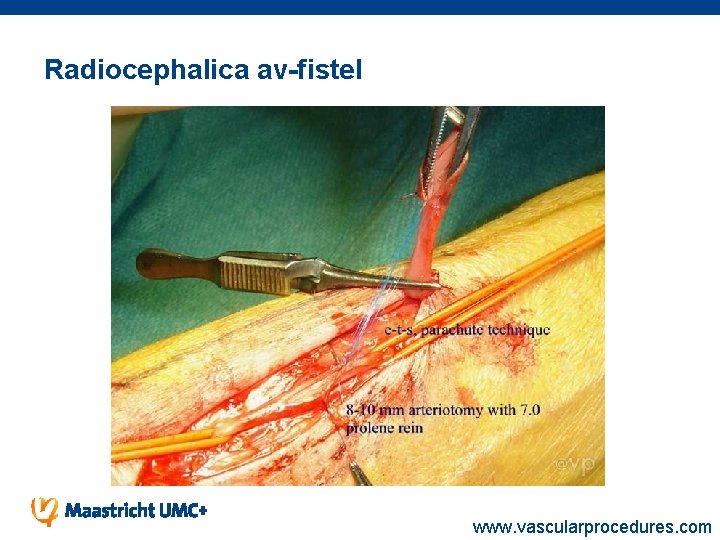 Radiocephalica av-fistel www. vascularprocedures. com 