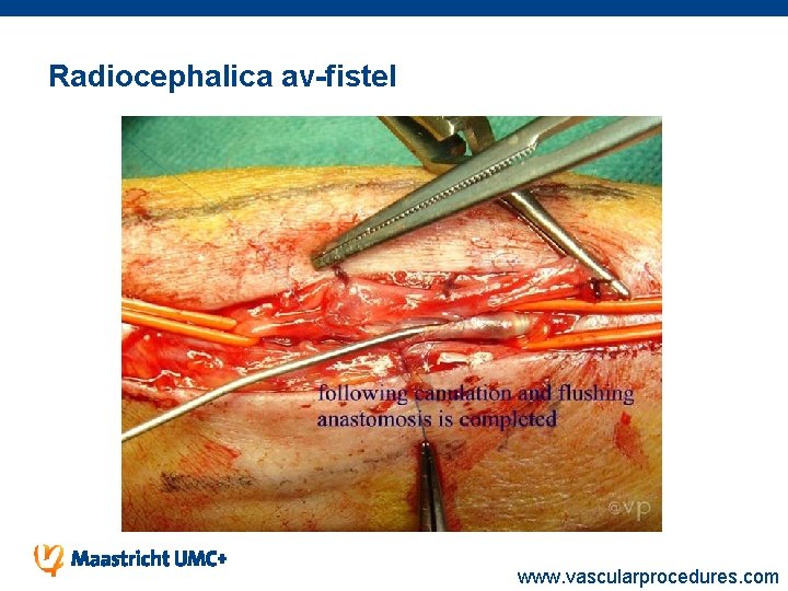 Radiocephalica av-fistel www. vascularprocedures. com 