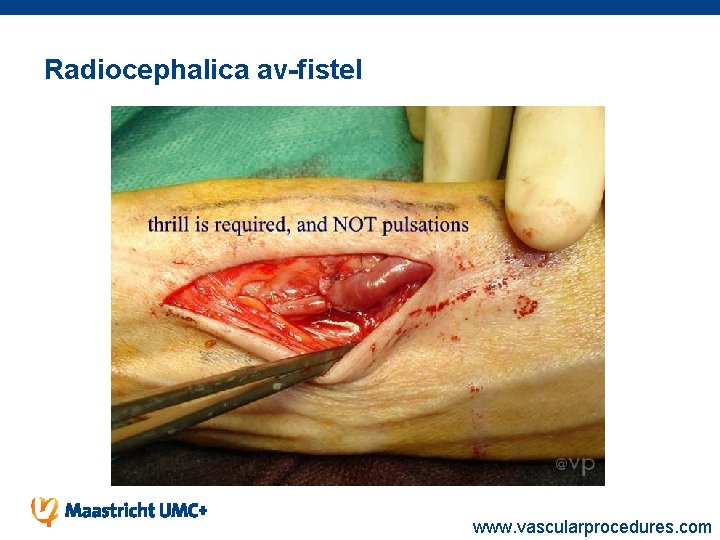 Radiocephalica av-fistel www. vascularprocedures. com 