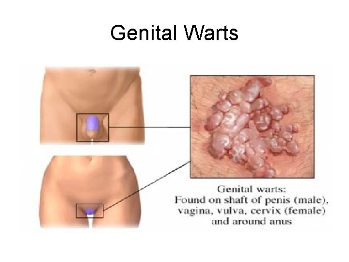 Genital Warts 