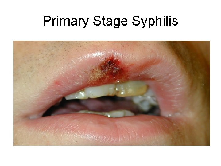 Primary Stage Syphilis 