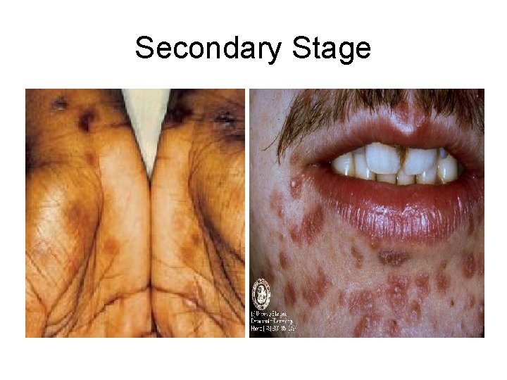 Secondary Stage 