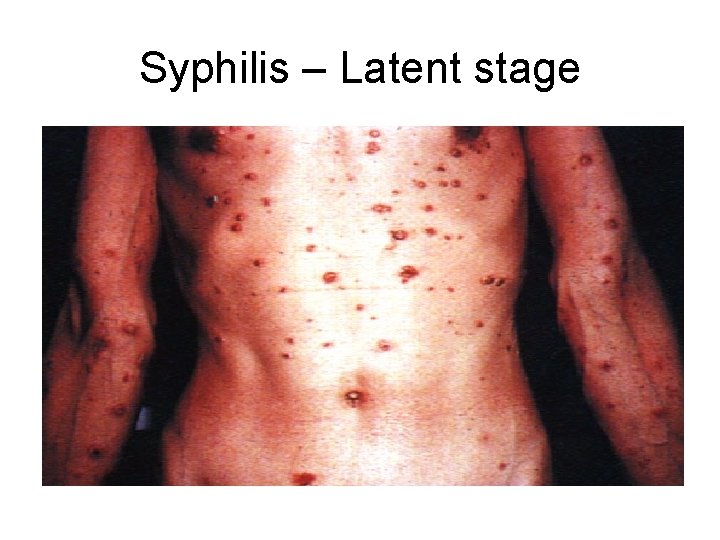 Syphilis – Latent stage 