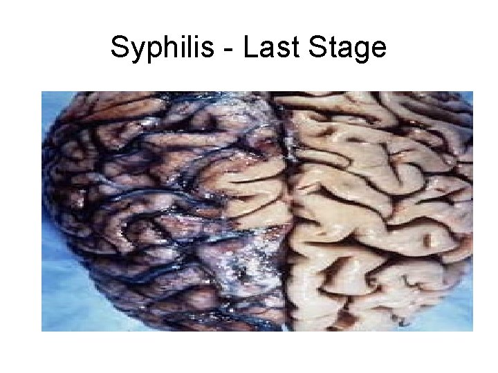 Syphilis - Last Stage 