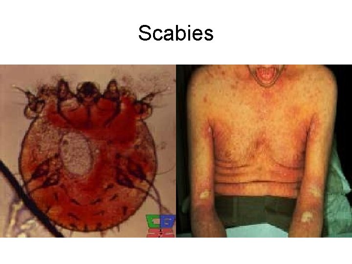 Scabies • 