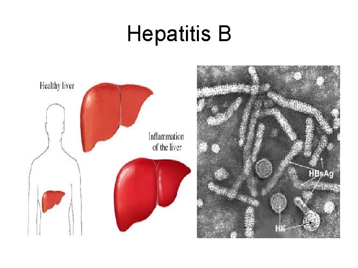 Hepatitis B 