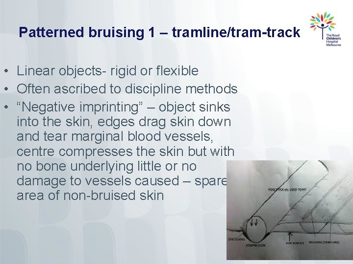 Patterned bruising 1 – tramline/tram-track • Linear objects- rigid or flexible • Often ascribed