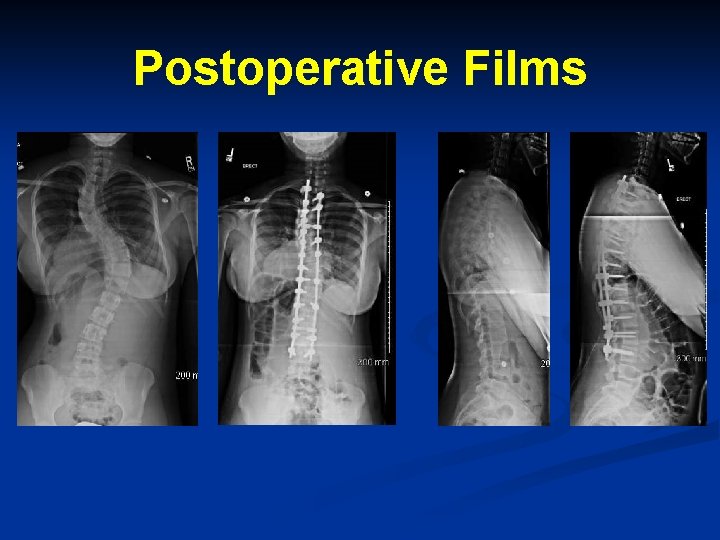 Postoperative Films Postoperative Films