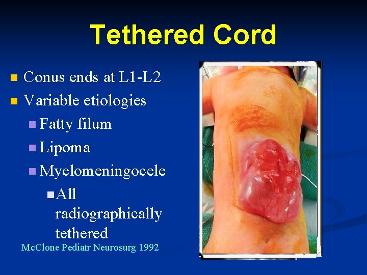 Tethered Cord n n Conus ends at L 1 -L 2 Variable etiologies n Tethered Cord n n Conus ends at L 1 -L 2 Variable etiologies n