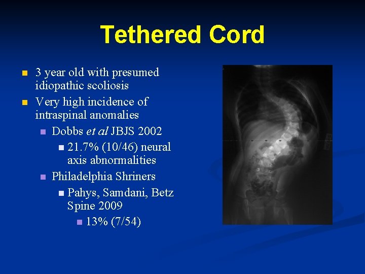 Tethered Cord n n 3 year old with presumed idiopathic scoliosis Very high incidence Tethered Cord n n 3 year old with presumed idiopathic scoliosis Very high incidence
