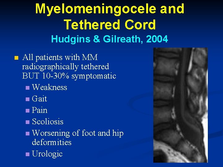 Myelomeningocele and Tethered Cord Hudgins & Gilreath, 2004 n All patients with MM radiographically Myelomeningocele and Tethered Cord Hudgins & Gilreath, 2004 n All patients with MM radiographically