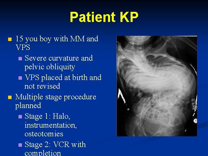 Patient KP n n 15 you boy with MM and VPS n Severe curvature Patient KP n n 15 you boy with MM and VPS n Severe curvature