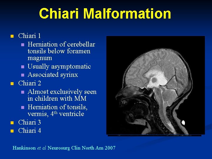 Chiari Malformation n n Chiari 1 n Herniation of cerebellar tonsils below foramen magnum Chiari Malformation n n Chiari 1 n Herniation of cerebellar tonsils below foramen magnum