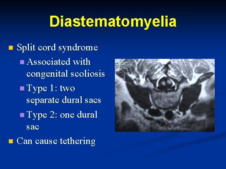 Diastematomyelia n n Split cord syndrome n Associated with congenital scoliosis n Type 1: Diastematomyelia n n Split cord syndrome n Associated with congenital scoliosis n Type 1: