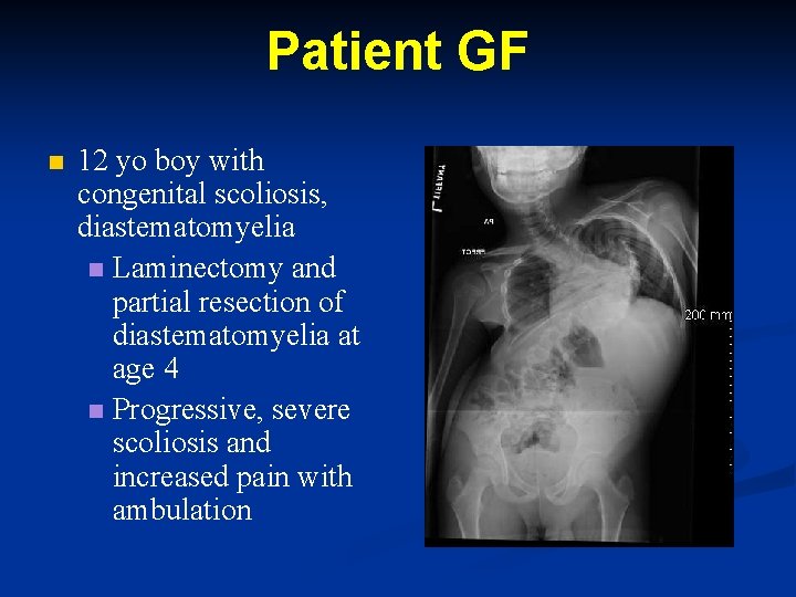Patient GF n 12 yo boy with congenital scoliosis, diastematomyelia n Laminectomy and partial Patient GF n 12 yo boy with congenital scoliosis, diastematomyelia n Laminectomy and partial