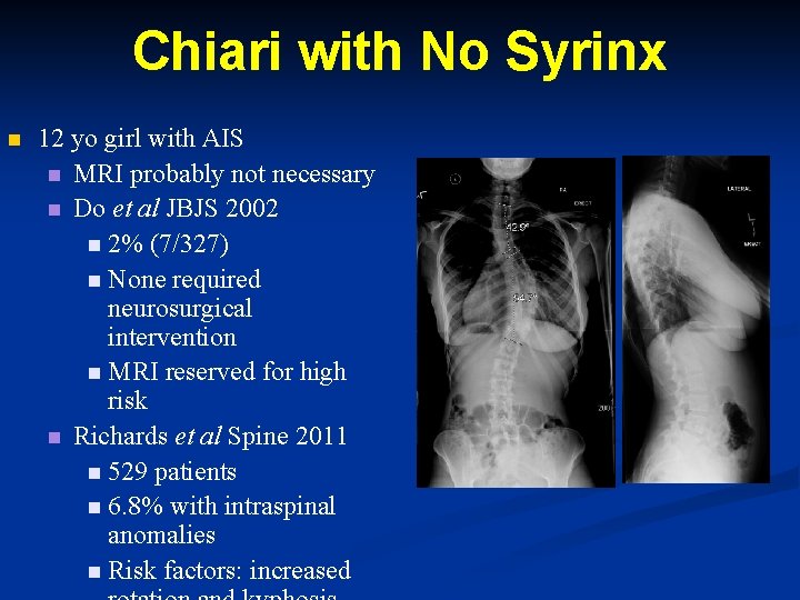 Chiari with No Syrinx n 12 yo girl with AIS n MRI probably not Chiari with No Syrinx n 12 yo girl with AIS n MRI probably not