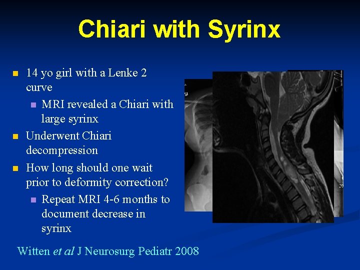 Chiari with Syrinx n n n 14 yo girl with a Lenke 2 curve Chiari with Syrinx n n n 14 yo girl with a Lenke 2 curve