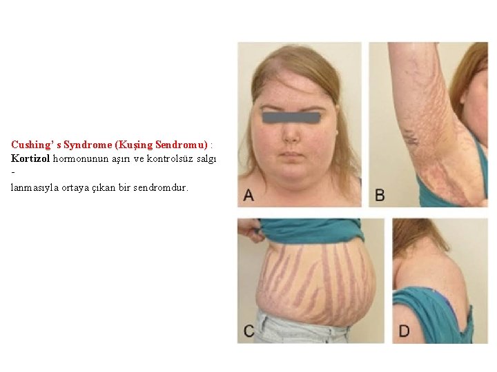 Cushing’ s Syndrome (Kuşing Sendromu) : Kortizol hormonunun aşırı ve kontrolsüz salgı lanmasıyla ortaya