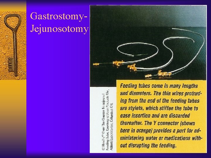 Gastrostomy. Jejunosotomy 