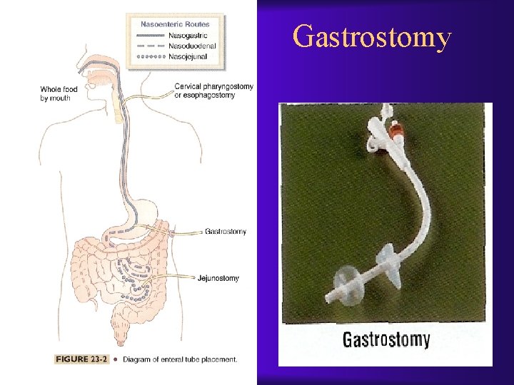 Gastrostomy 