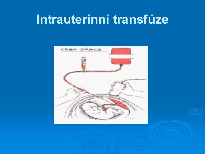 Intrauterinní transfúze Intrauterinní transfúze