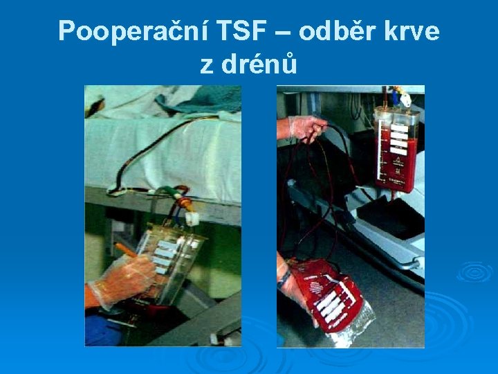 Pooperační TSF – odběr krve z drénů Pooperační TSF – odběr krve z drénů