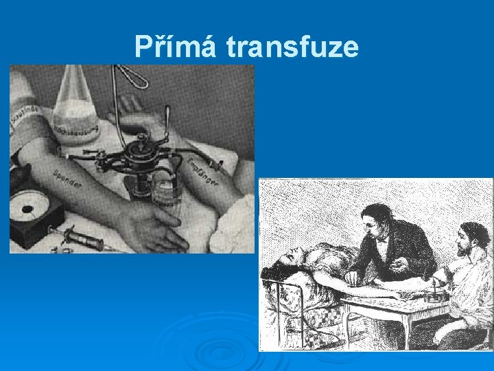 Přímá transfuze Přímá transfuze