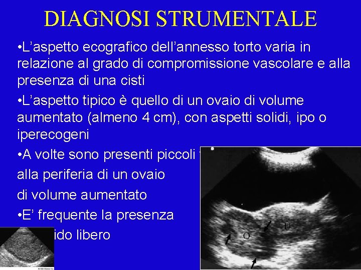 DIAGNOSI STRUMENTALE • L’aspetto ecografico dell’annesso torto varia in relazione al grado di compromissione